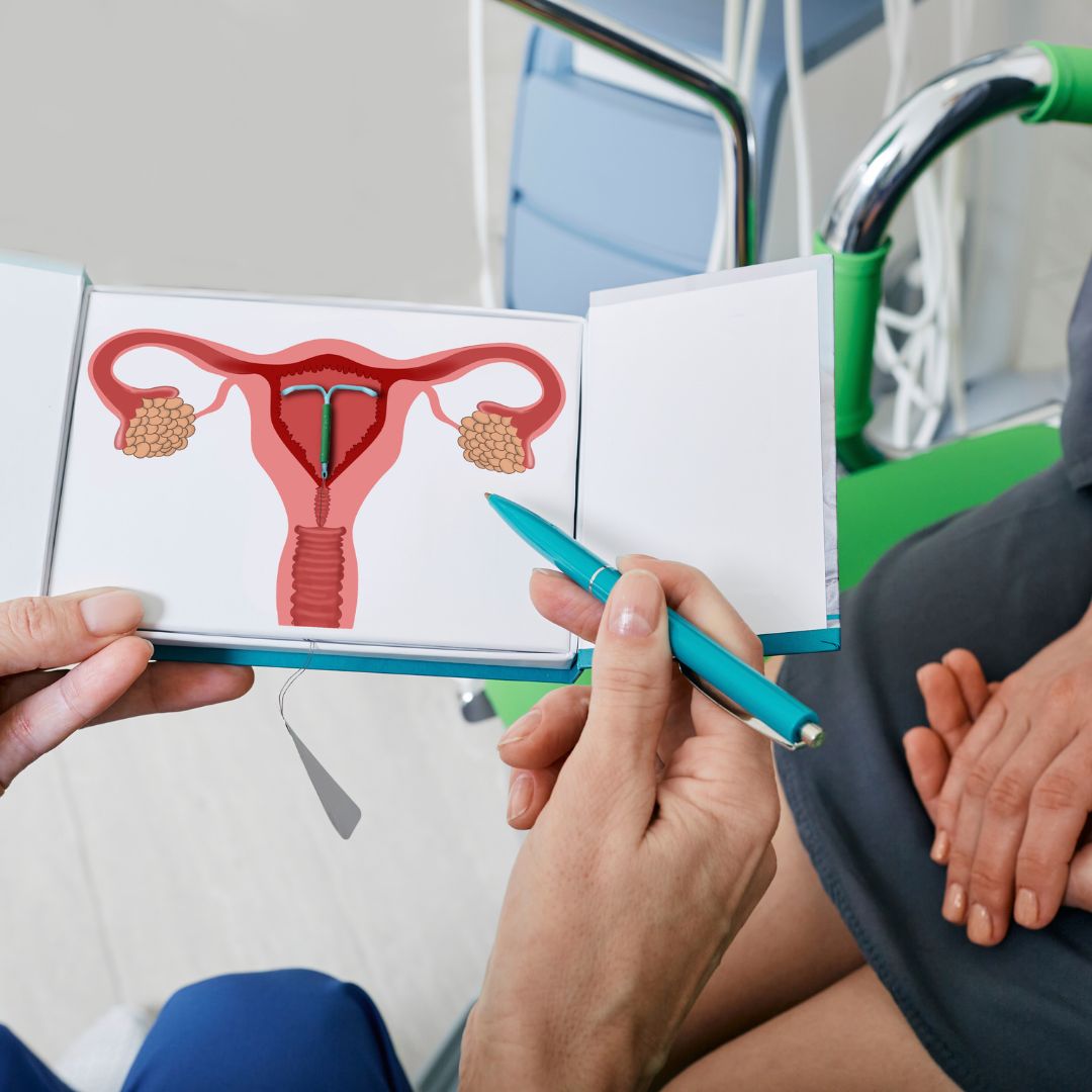 KB iud
