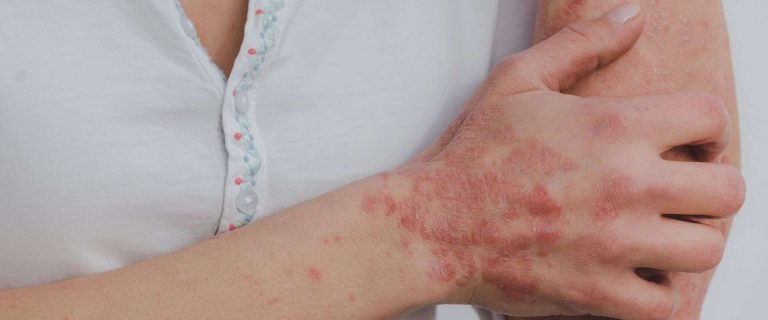cara mengatasi psoriasis