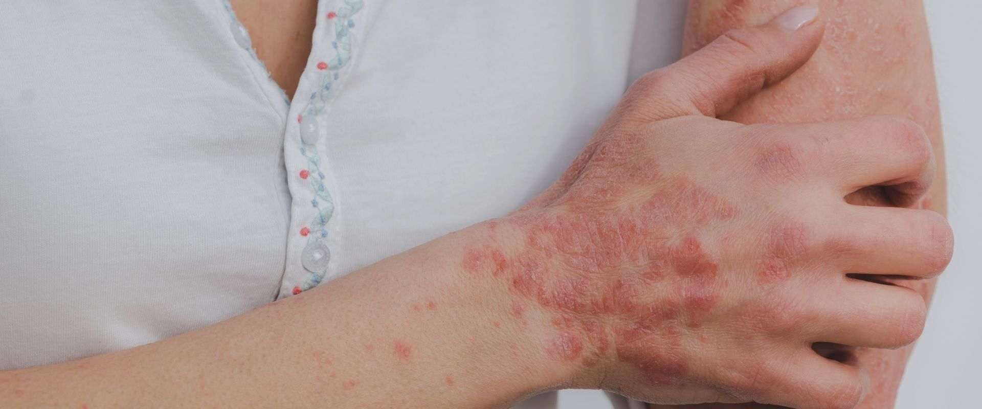 cara mengatasi psoriasis